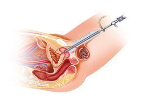 Laparoscopic Hysterectomy surgeon in Aundh